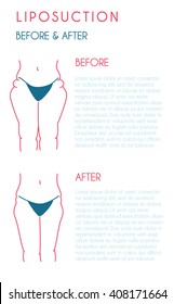 Liposuction poster. Modern vector style.
