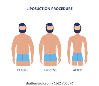 Liposuction procedure before and after - cartoon man during weight loss surgery process with fat and slim body isolated on white background. Flat vector illustration.