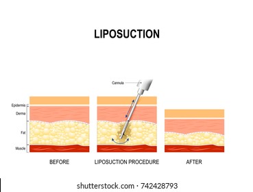 liposuction procedure. Before and after. fat modeling and surgery