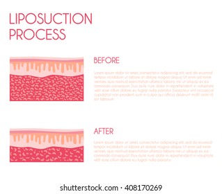 Liposuction process. Modern vector style.