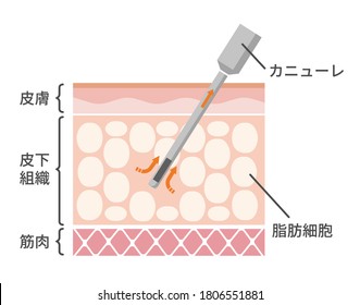 Ilustración vectorial del proceso de liposucción. Traducción: Dermis, hipodérmica, muscular, células grasas, cánula