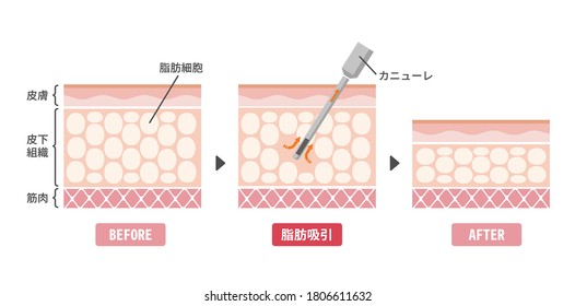 Liposuction process vector illustration.  Translation: Liposuction, Dermis, Hypodermis, Muscle, Fat cells, Cannula