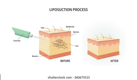 Liposuction process.Suction-assisted liposuction. Vector illustration