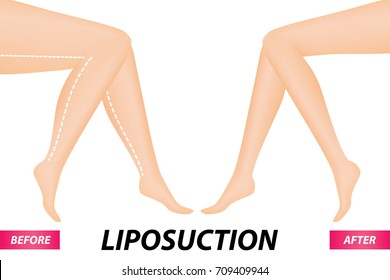 liposuction surgery , leg fat before and after vector illustration