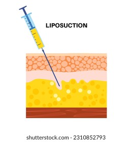 procedimiento de cirugía de liposucción. Sumisión para eliminar grasa del cuerpo obeso. Problema de obesidad. Concepto de sobrepeso. Estructura de las capas de piel epidermis, dermis e hipodermis ilustración vectorial plana