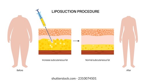 cirugía de liposucción, silueta antes y después del procedimiento. Eliminar grasa del cuerpo obeso. Problema de obesidad. Concepto de sobrepeso. Ilustración vectorial de la estructura de las capas cutáneas epidermis, dermis e hipodérmis