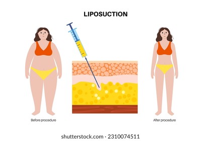 liposuction surgery, silhouette before and after procedure. Remove fat from obese body. Obesity problem. Overweight concept. Skin layers structure epidermis, dermis and hypodermis vector illustration