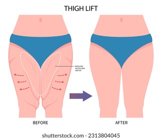 Liposuction Thigh lift or Thighplasty leg cosmetic weight loss bariatric surgery with body hip cellulite reducing contour of mass Index and BMI removal