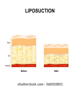 Liposuction is a type of cosmetic surgery for remove fat from the human body. The Human Skin layer before lipo and after Liposuction.