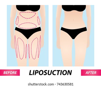 Liposuction , woman fat surgery before and after vector illustration