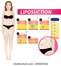 liposuction , woman fat surgery vector illustration