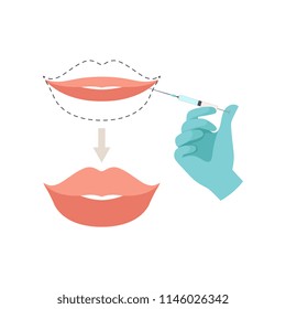 Lips augmentation procedure, hyaluronic acid lip injections vector Illustration on a white background