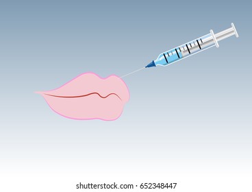 Lips and filler injection