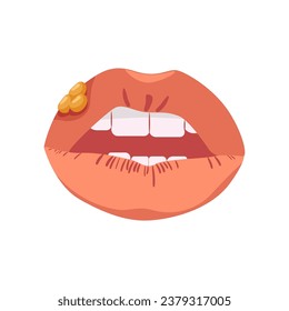 Labios con herpes. Enfermedad infecciosa que afecta a las membranas mucosas en forma de ampollas con procesos vectores ulcerativos inflamatorios