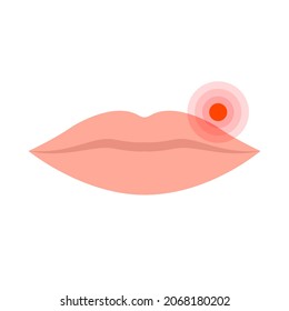 Lips with herpes virus on a white background. Vector stock illustration. 