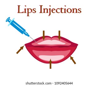 Lips injection isolated, vector illustration