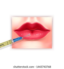 Lips injection, Lip Augmentation. injectable cosmetic filler. Vector EPS 10 illustration in cartoon style for biology, scientific, and medical use.