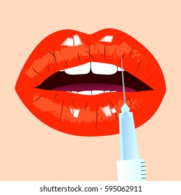 Lips injection. Red lips. Beauty concept, vector illustration.