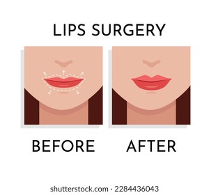 Lips Chirurgische Korrektur Vektorgrafik. Konzept der plastischen und ästhetischen Chirurgie. Beauty-Verfahren auf Frauen Gesicht mit gestrichelten Linien auf Lippen und anatomischen Zonen Up und Down flachen Design-Cartoon-Stil