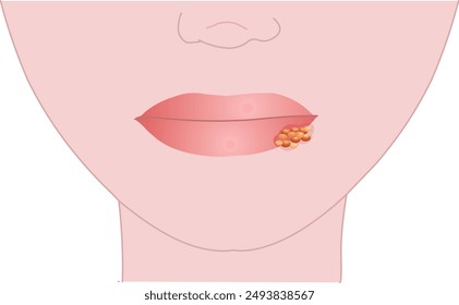 Virus de los labios herpes labial infectado, virus del herpes simple tipo, VHS1. Anatomía contagiosa de la herida, diagrama de vista lateral de la piel. Problema facial, bucal, bucal. Dermatología, medicina. Ilustración vectorial