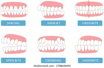 
List of dentitions that require treatment: crowding, opposite occlusion, open bite, maxillary anterior protrusion, cavities, dentition