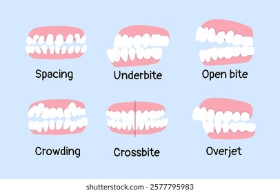 list of orthodontic dental problem spacing, underbite, open bite, crowding, crossbite, overjet