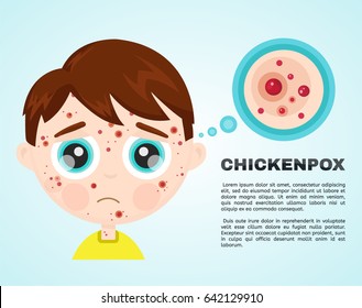 Little boy baby kid face sick chickenpox virus infographic icon design. Vector flat character illustration. Looking rash of children which has symptoms of smallpox chickenpox.disease diagnose.red rash