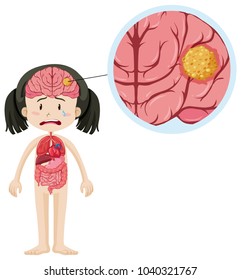 Little Girl And Brain Cancer Illustration