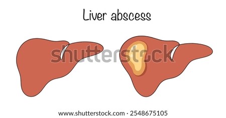 Liver abscess. A cavity in the thickness of the liver parenchyma, limited by a capsule, filled with purulent masses. Drawn healthy liver and liver abscess. Colored vector for different uses.