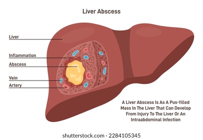 Liver abscess. Human internal organ tissue inflammation and pus formation. Bacterial infection disseminated from the portal vein. Flat vector illustration