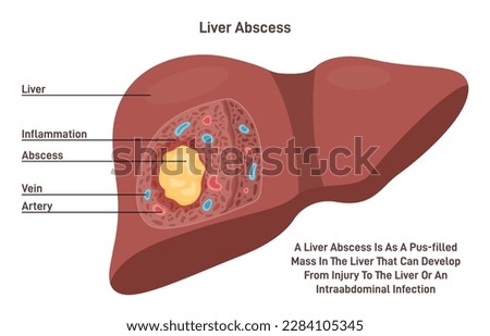 Liver abscess. Human internal organ tissue inflammation and pus formation. Bacterial infection disseminated from the portal vein. Flat vector illustration