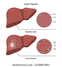 Liver cancer. Comparison between healthy organ and liver with carcinoma diagnosis. Liver cell strucure, human organ responsible for detoxification the organism. Flat vector illustration