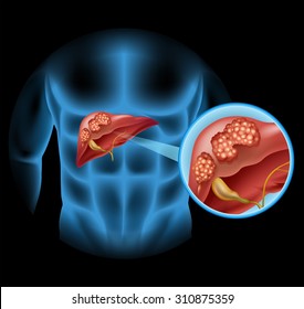 Liver Cancer diagram in detail illustration