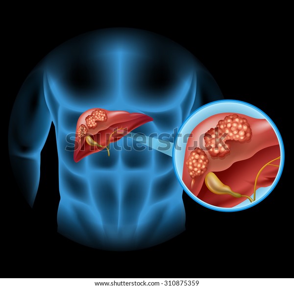 Liver Cancer Diagram Detail Illustration Stock Vector (Royalty Free ...