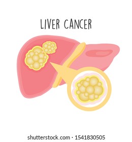 Liver Cancer flat vector illustration.
