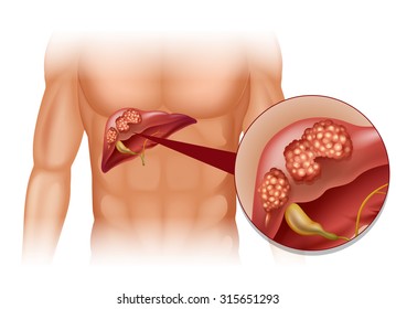 Liver Cancer In Human Illustration