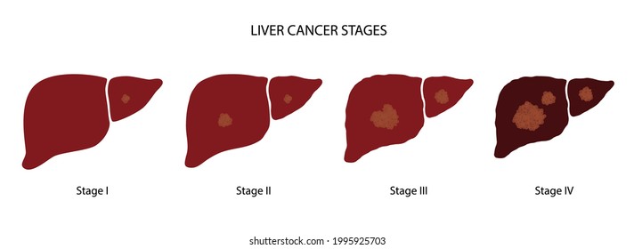 Liver cancer logo. Stages of liver damage. Pathogen disease and tumor in human digestive system. Internal organ with carcinoma. Pain and inflammation in human body. Medical poster vector illustration.