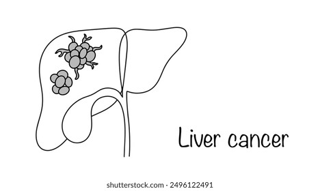 Liver cancer. Malignant neoplasm developing from hepatocytes. A tumor that is localized in the liver. Degeneration of liver cells. Vector.