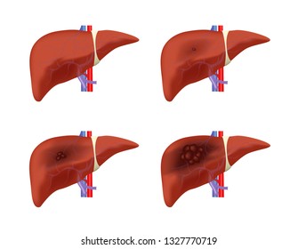 Liver Cancer Stages Vector / Tumor