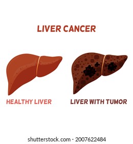 Liver Cancer Tumor Dark Spots On Stock Vector (Royalty Free) 2007622484 ...