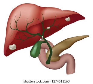 Liver Cholangiocarcinoma Perihilar & Distal