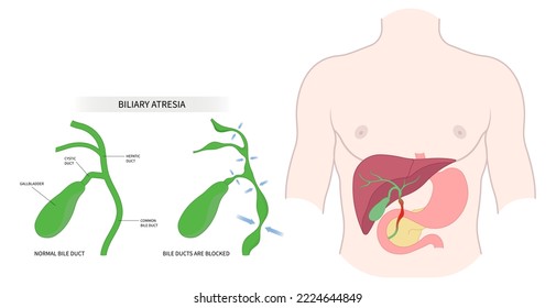 Liver Cirrhosis With Bile Duct Obstruction That Causes Inflammation In Adults The Medical Anatomy