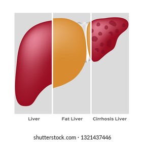 Liver cirrhosis concept vector