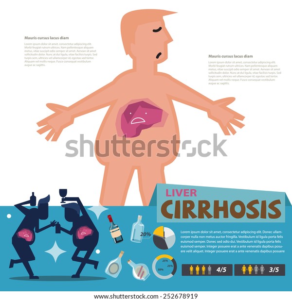 Liver Cirrhosis Infographic Vector Illustration Stock Vector Royalty
