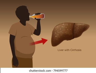 Liver with Cirrhosis of People who drink liqueur heavily over a long period of time. Illustration about health and medical.