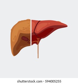 liver cirrhosis vector illustration