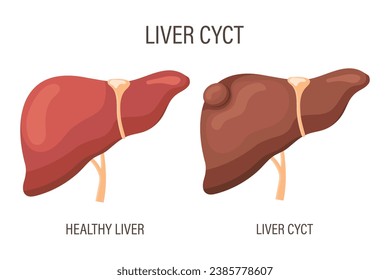 Liver cyst, liver disease. Healthy liver and liver cyst. Medical infographic banner. Vector