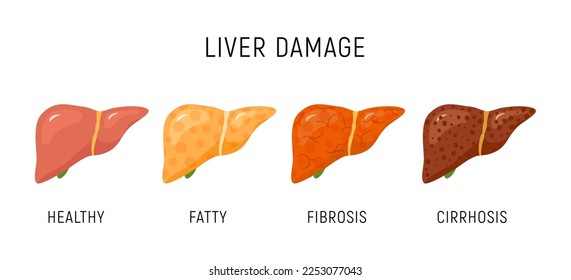 Diagrama de infografía de daño hepático anatomía de cáncer. Lesión hepática órganos tejido hepático estadios de fibrosis