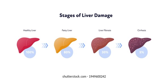 Liver damage infographic. Vector flat illustration. Anatomical human organ. Stages of cirrhosis disease from healthy to fatty and fibrosis. Arrow and percent sign. Design for health care, education