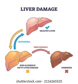 Liver damage stages with reversible and irreversible disease outline concept. Labeled educational healthy inner organ, non alcoholic fatty illness and medical cirrhosis impact vector illustration.